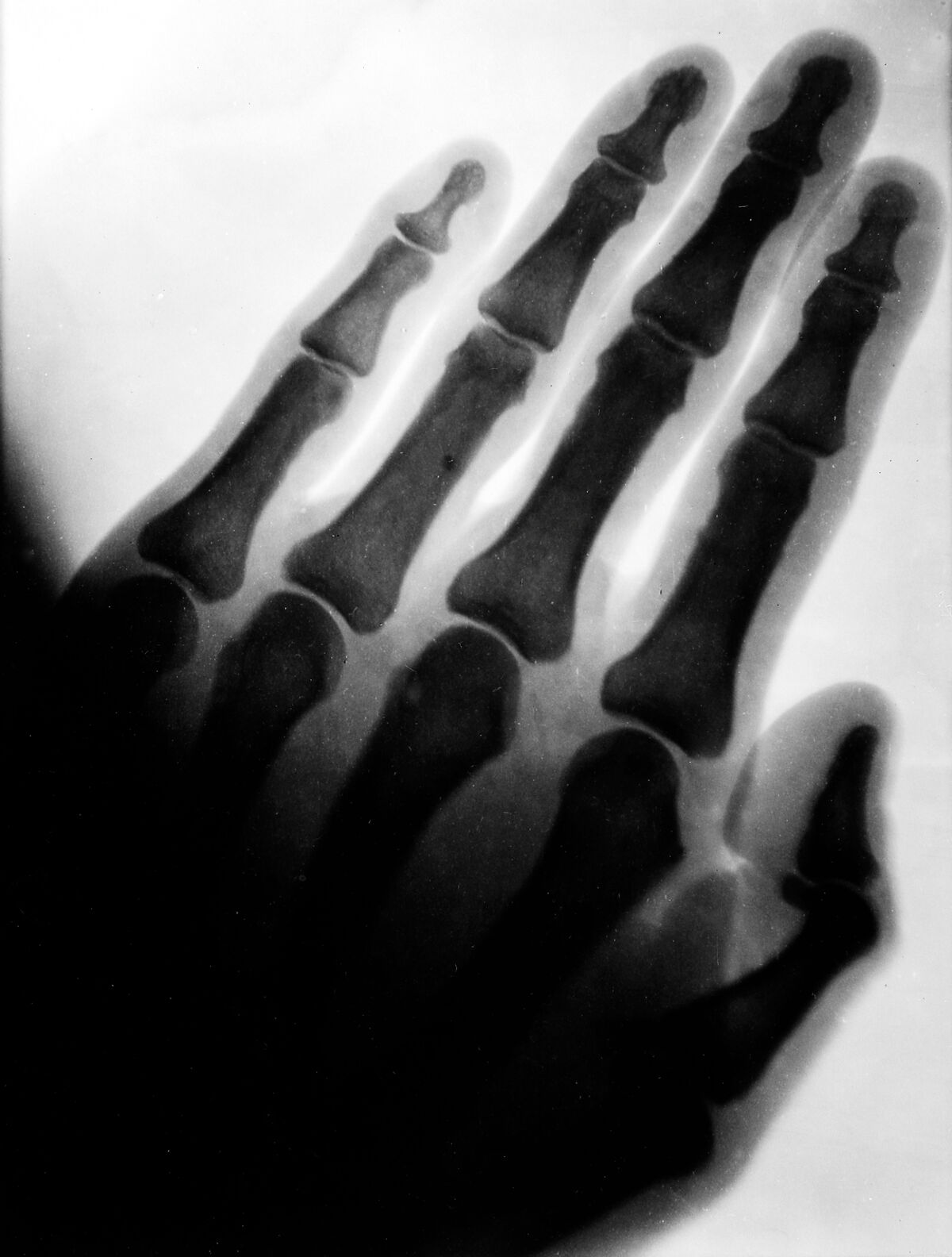 Early radiograph showing the bones of an adult hand